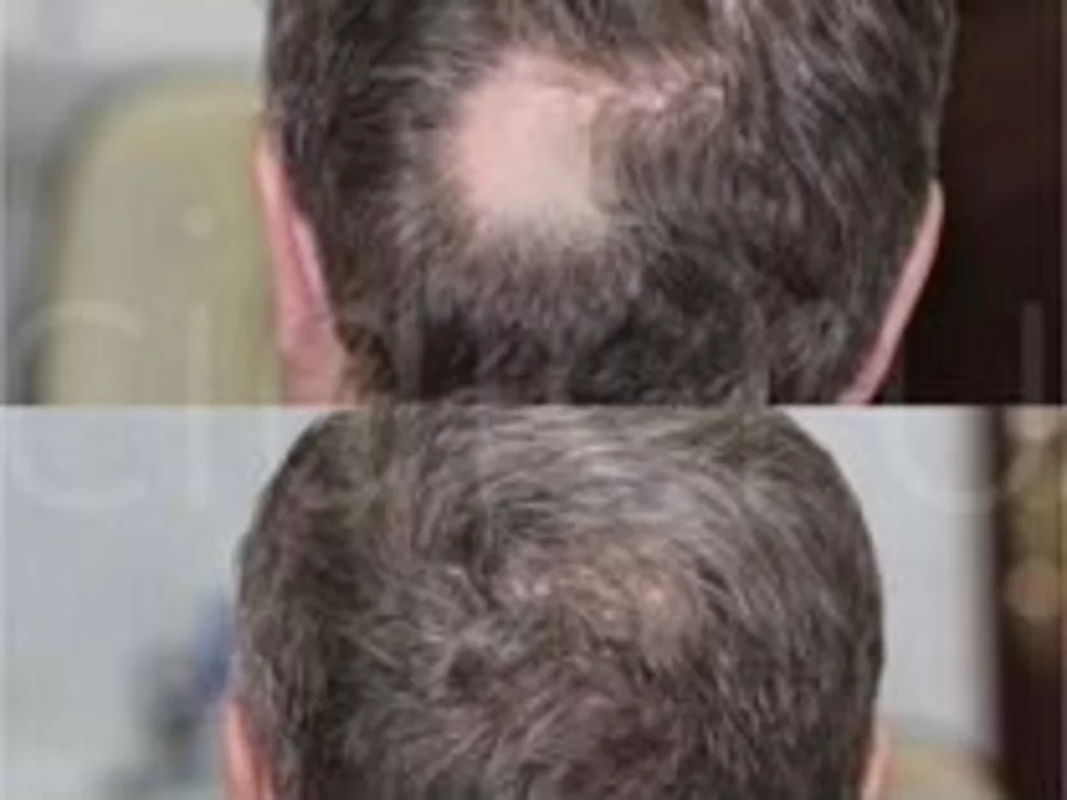 I benefici del massaggio del cuoio capelluto per i sofferenti di alopecia androgenetica